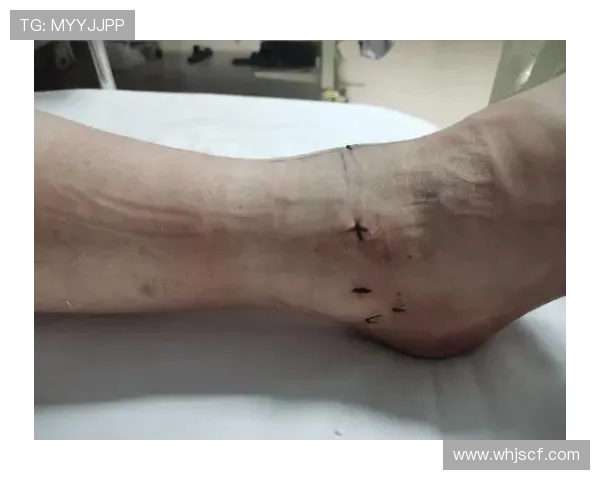 米西右脚踝扭伤后恢复良好 表示现在感觉好多了认为自己已无大碍